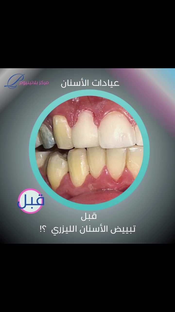 مركز بلاتينيوك كلينك الطبي 
عيادات الأسنان #
⁨ 📌 موقعنا: بغداد – المحمودية – حي 17 – مجاور منفذ كرار الطائي_باتجاه معهد اوراس 
📞 للحجز:
***********

#بغداد #بلاتينيوم_كلينك #المحموديه #المحمودية⁩
