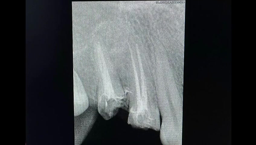 حشوات جذر, بناء الاسنان, تراكيب الزركون.

عيادة د.عمار عزيز لطيف 👨‍⚕️💗
بغداد / رحمانية الشعله / عمارة الوليد 
للإستفسار الاتصال على 
***********
***********
واتس اب https://wa.me/9647777495690
