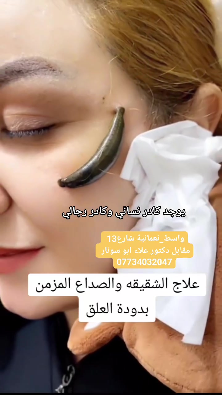 🩸 معالجة الشقيقة بالعلق الطبي 🩸
العلق الطبي Hirudo medicinalis يعالج الشقيقة والصداع، ويساعد على تحسين الدورة الدموية وتخفيف الأعراض.
👩‍⚕️ يوجد كادر نسائي
👨‍⚕️ يوجد كادر رجالي
📍 العنوان: محافظة واسط – قضاء النعمانية – شارع 13 مقابل دكتور علاء أبو سونار
📞 للحجز والاستفسار: ***********
#العلق_الطبي #معالجة_الشقيقة #الشقيقة #الحجامة_النسائية
 #الجميع @إشارة #متابعين

