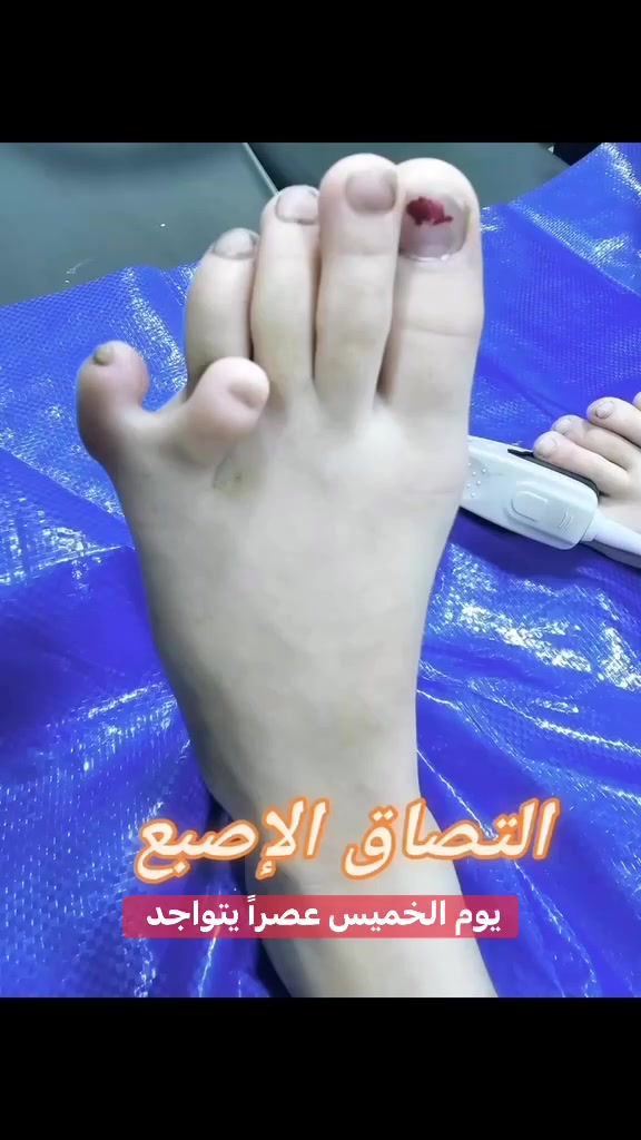 🔴يوم الخميس  عصرا يتواجد الدكتور حسن محي الدين رشيد 

                         دكتوراه أخصائي امراض وجراحة العظام والكسور والتهاب المفاصل وتبديل المفاصل والروماتيزم والاصابات الرياضية

 اجرى الدكتور حسن محي الدين عملية جراحية (( التصاق الإصبع)) ولله الحمد والشكر من قبل ومن بعد تكللت العملية بنجاح
                                    
 🟢 للحجز والاستفسار  :*********** - ***********

🟢العنوان / مجمع الثقة الطبي طوزخورماتو / شارعة الصاغة / قرب مدرسة يافا الابتدائية
