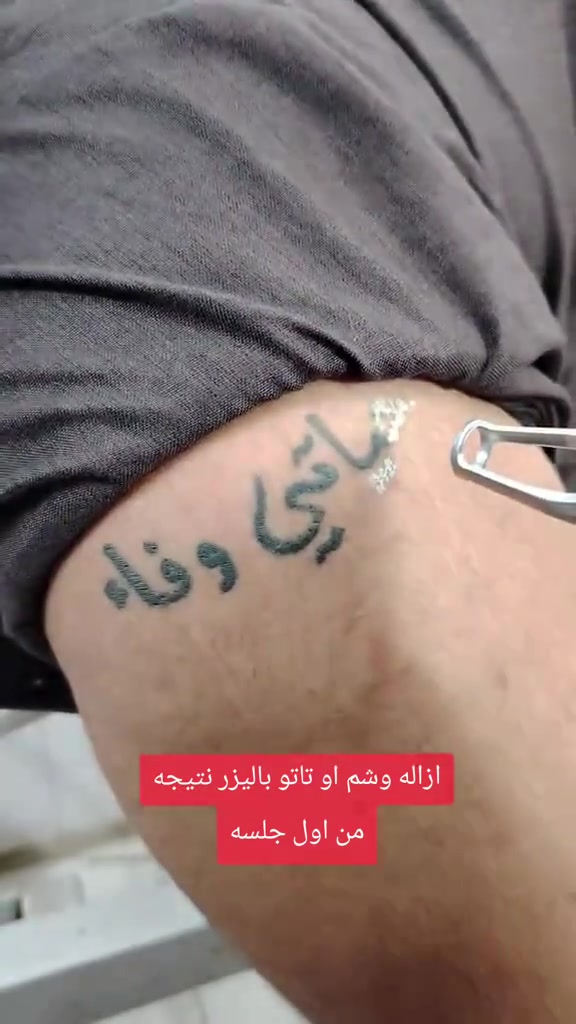 ازاله وشم داخل الصالون ونتائج روعه
تقشير كاربوني 
توريد شفه 
ازاله تاتو
كزافير علي ✂️✂️
***********
رجالي نسائي
