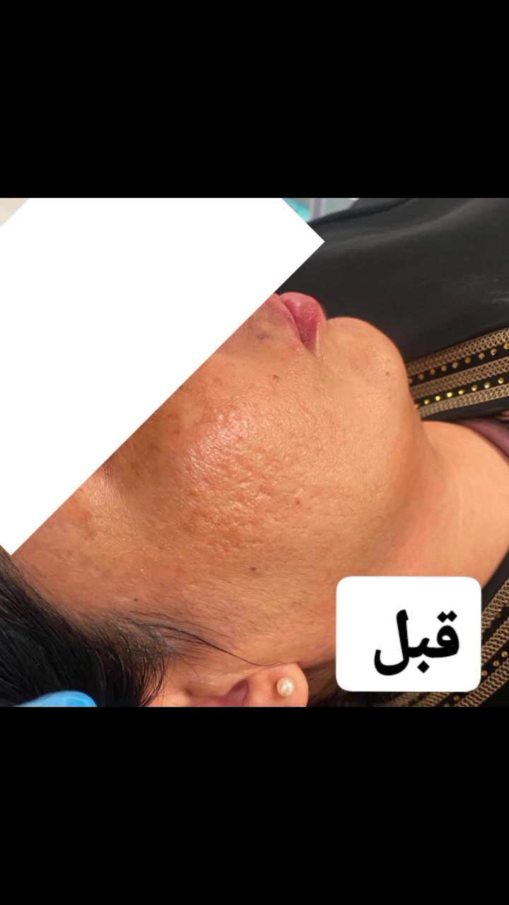 ✨ شوفي الفرق بنفسج!

من بشرة تعاني من الندوب والتصبغات 😔
إلى بشرة أكثر صفاءً وإشراقاً وتجانساً ✨🤍

قبل ➡️ بعد
كل بشرة إلها احتياج مختلف، والنتيجة تبدأ من التشخيص الصحيح واختيار الخطة المناسبة 🌷

إذا تعانين من نفس المشكلة، لا تترددين تتواصلين ويانا 🤍✨

📍 بغداد – الزعفرانية
📲 للحجز والاستفسار: ***********

#قبل_وبعد #علاج_الندوب
