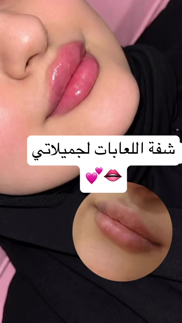 فلر • تجميل الوجه