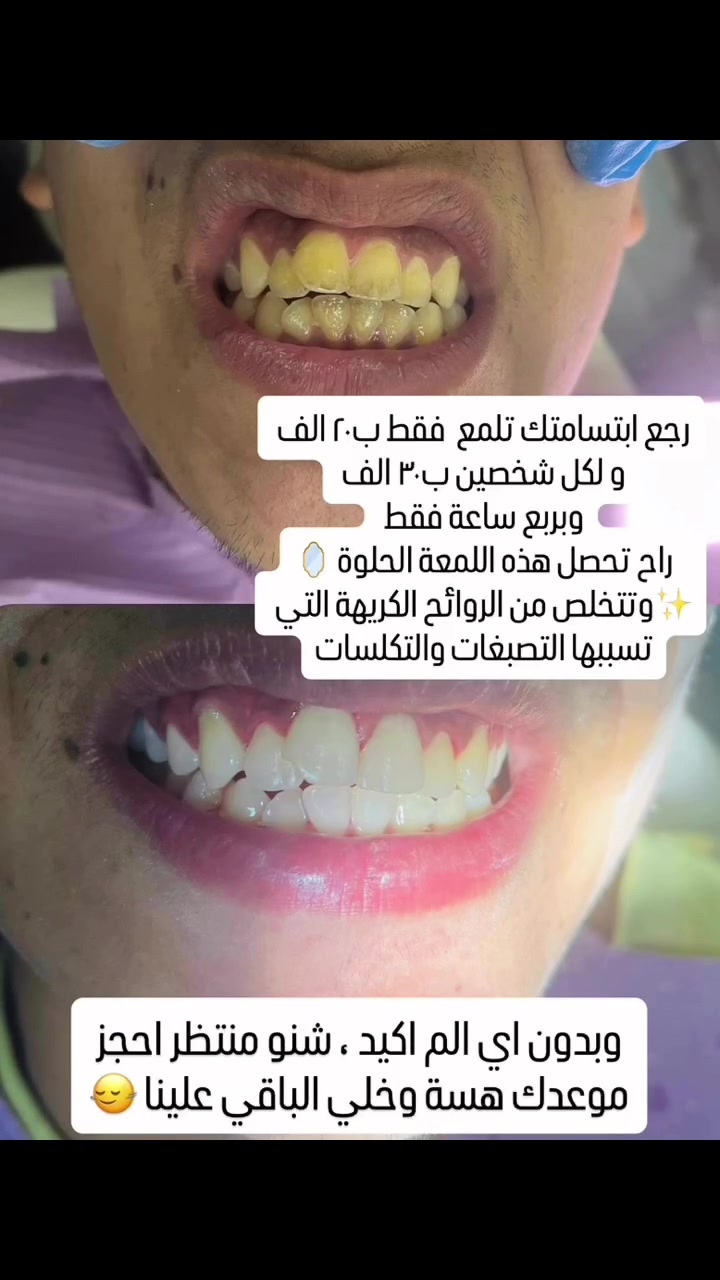 رجّع ابتسامتك تلمع بـ20 ألف بس! 🦷✨

وإذا تجون اثنين؟
شخصين بـ30 ألف بس! 🔥

وبـ ربع ساعة فقط ⏱️
راح تحصل على هاللمعة الحلوة 🪞✨
وتتخلص من التصبغات والتكلسات وتراكمات الأسنان والريحة المزعجة.

ربع ساعة بس… والفرق يبين! 😍
📩 احجز موعدك هسه وخلي ابتسامتك تلمع

رقم الحجز ***********
مفتوح طوال اليوم للحجز والرد على استفساراتكم 

عيادة الجمال هي عائلة تكبر وياكم وبيكم 
#اكسبلور#explore#
