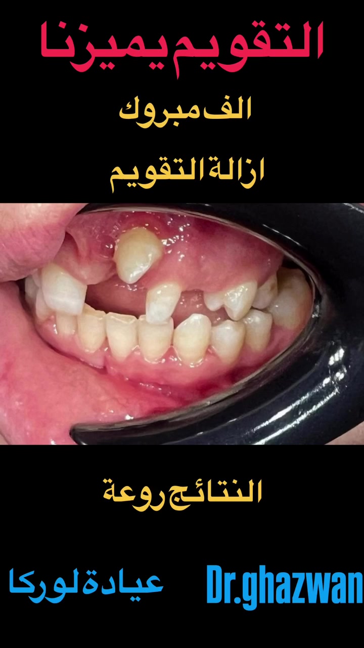 التقويم يميزنا احد اعقد و اصعب الحالات لمريض يتجاوز ٤٠ سنة حيث يفقد للأسنان الامامية العليا و وجود الناب في منتصف الخد ( الصور تتكلم)… الحمد تمت ازالة التقويم و الوصول الى مرحلة شبه نهائية كان المفروض بعض الملاحظات لكن تعرض المريض إلى مرض صحي يتطلب اجراء رنين و مفارز لمنطقة الراس و الدماغ و يتطلب ذلك ازالة التقويم بشكل فوري و تمت الإزالة …. علاج جميع الحالات الصعبة و المستعصية نتائج مضمونة خبرة متميزة دقة في التشخيص و العلاج ابتسامة مثالية… دكتور غزوان مزهر بغداد الكرخ نفق الشرطة بداية شارع الاطباء عيادة لوركا فوق صيدلية كنز النفق متوفر واتس *********** #تقويم_الأسنان_والفكين #تقدمالفكالسفلي #العضة_المفتوحة #تقويم_الشفاف_للأسنان #تقويم_الأسنان_قبل_وبعد @زراعة_الاسنان @تعليف_الاسنان @تغليفات_الزاركون_للاسنان @ابتسامة_الاسنان
