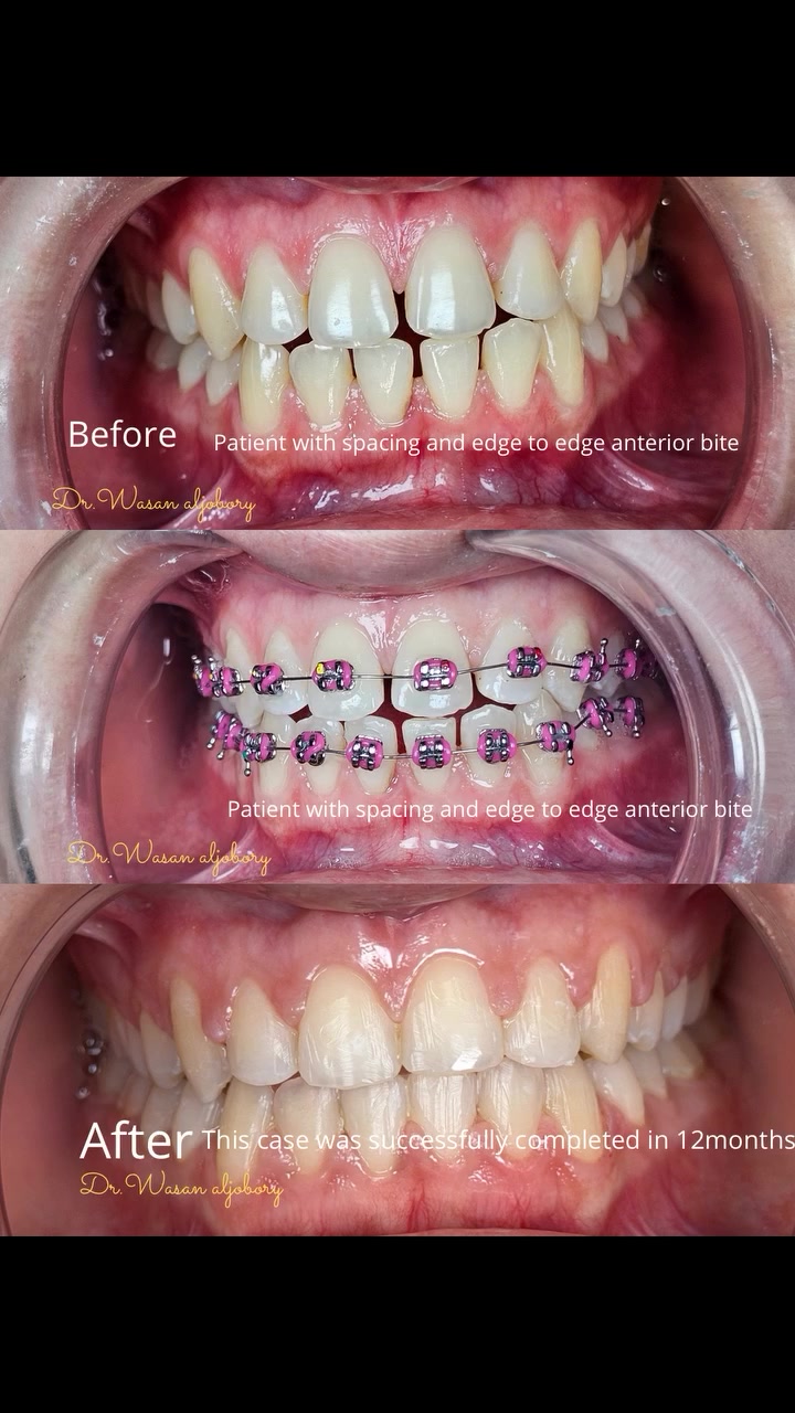 The patient presented with spacing and an anterior edge-to-edge bite.

Treatment was performed using fixed metal braces, with excellent results achieved in just 12 months.
