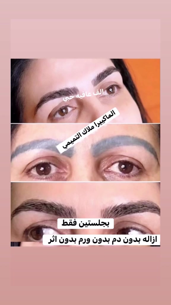 ازاله تاتو بدون دم بدون ورم بدون اثر
شوفين نتيجة الازاله بنفس الوقت
مستمره عروض الازاله 
احجزي  موعدج الان 

للحجز مراسلة الصفحة او الأتصال على الرقم 
*********** 
موجود وات ساب
