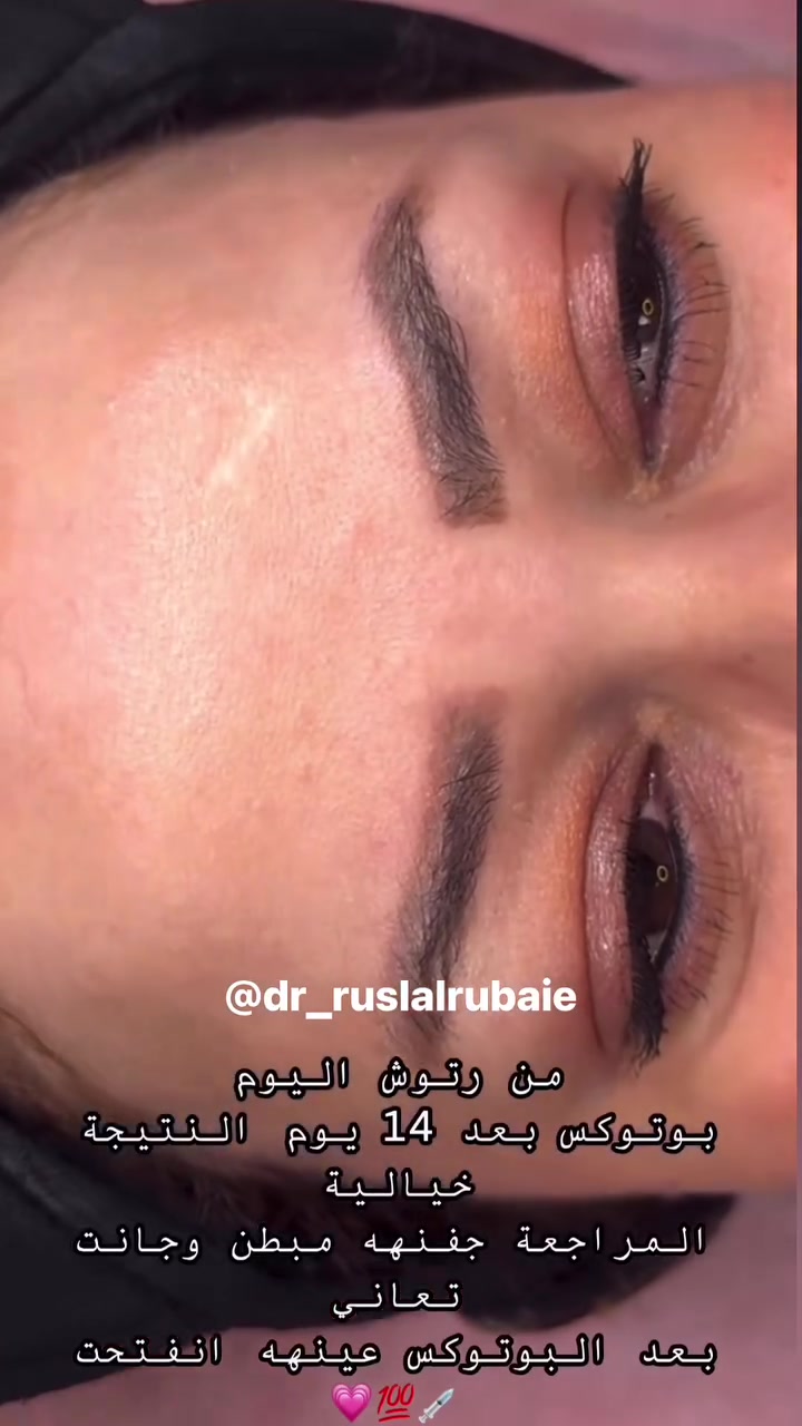عروض شهر التاسع
مراجعاتي  الحلوات ورأيهم صوت وصوره ماشاءالله الفرق ديشوفو من اول الجلسات لان الاختيار يكون مو عشوائي كل مراجعة نختارلها مكس او ابرة خاصة لحالتها💉💗💗👏 وهو هذا الشغل الصح الي يخليكم تشوفون فرق من الجلسة الاولى 💉🍓

بخصوص العروض مراح تتكرر بعد ابداً لان اقوى عروض سويناهه 

خلال شهر التاسع واقبالكم عليه جداً عالي 💉👏

بخصوص كل المواد الجديدة الي تنزل داخل العياده تكدرون تتابعون صفحة الانستكرام 

https://www.instagram.com/p/DbWWdUhsNAt/?stkn=Z2EwenVjcm5rOXFu

او صفحتنا على الفيسبوك DrRusl Alrubaie

او مراسلتنا واتساب مسج فقط ***********

نص مكتوب في الصور:
- نتائج استمرار المراجعة بحقن ابر النضاره شهريا 0 ماشاء الله تلمع 🤭 ✨✨ وهذا السر الي يخليكم تشوفون فرق لان اختيار الابره يكون حسب الحالة ✨ @DrRusl_Alrubaie
- @dr_Ruslalrubaie
- Before @dr_ruslalrubaie After
- متواجدة دكتورة اهلا حبيبتي نعم متواجدة 9:44 AM مرحبا دكتورة دكتور تقطيع ألياف الحالة شكد PM مراحب حبيتي You replied ما شاء الله حالة مراجعتي تعاني من ندب ومسام واسع بسبب اثار حب الشباب بججلستين بس حصلت نتيجة دكتور تقطيع ألياف الحالة شكد شلونها حالتي بعد الجلسة? Replied to you شلونها حالتي بعد الجلسة? تجنن دكتورة DrRusl Alrubaie@ يعني ميحتاجلي شي بس ضل شوية يعني كولش بسيط اثر شوية سطحي أما المسام كولش صغر Message...