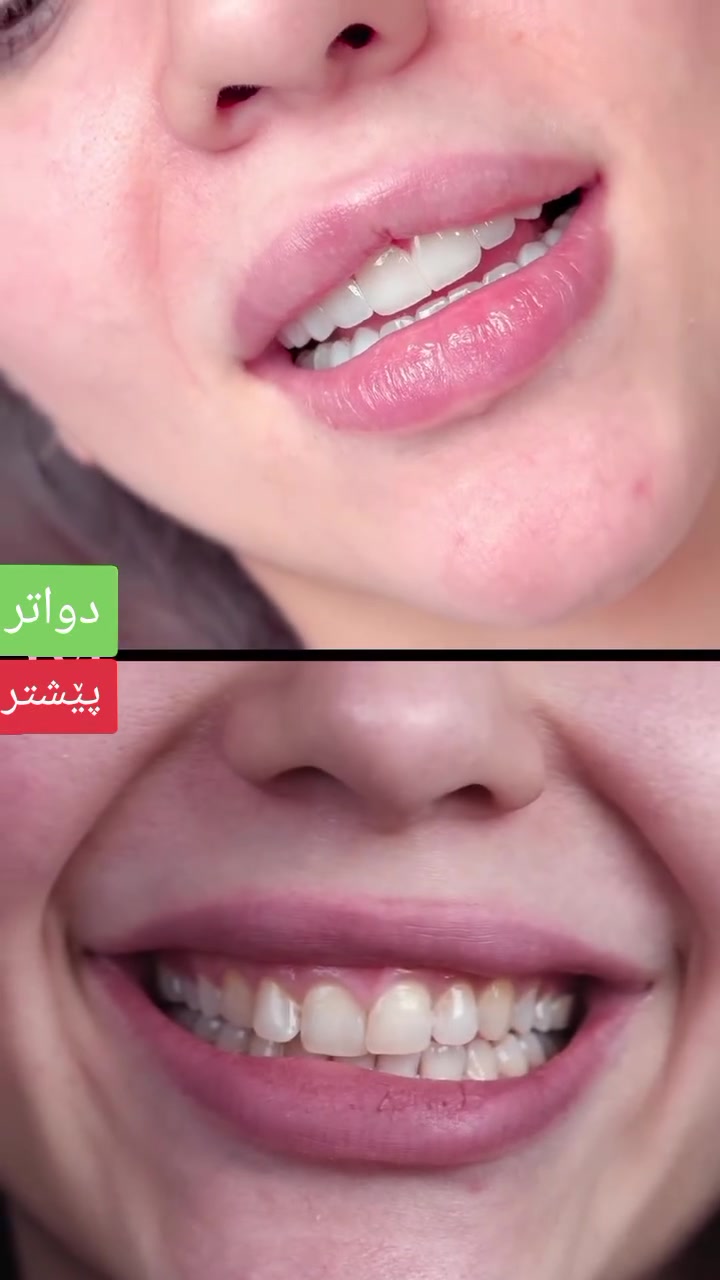 فۆلۆی پەیج • تەلاری نور • دوسایدی گۆڕان