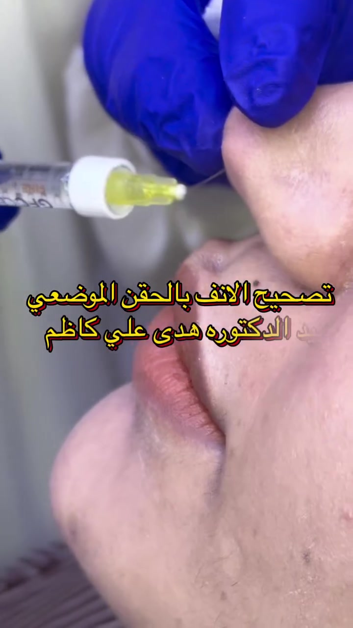 تصحيح الانف • حقن موضعي • مركز الهدى الطبي