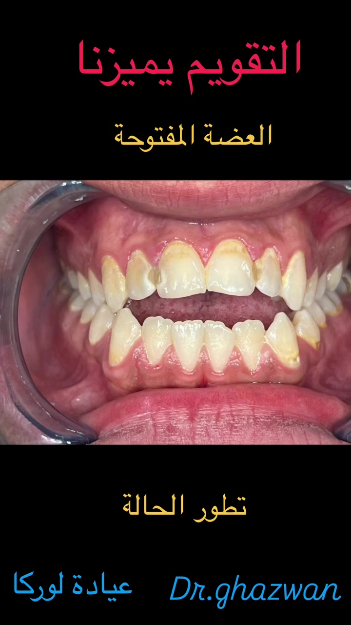 التقويم يميزنا احد الحالات العضة المفتوحة و عدم القدرة على غلق الاسنان يعاني من مظهر خارجي غير متناسق و عدم القدرة على تقطيع الطعام و انزعاجات مستمرة و مشاكل اخرى … علاج جميع الحالات الصعبة و المستعصية نتائج مضمونة خبرة طويلة في مجال العلاج ابتسامة مثاليه اسعار مناسبة بالتقسيط المريح… دكتور غزوان مزهر بغداد الكرخ نفق الشرطة بداية شارع الاطباء عيادة لوركا فوق صيدلية كنز النفق متوفر واتس *********** #تقويم_الأسنان_والفكين #تقويم_الأسنان_بأنواعه #العضة_المعكوسة #العضة_المفتوحة #العضة_العميقة @حشوات_الجذور
