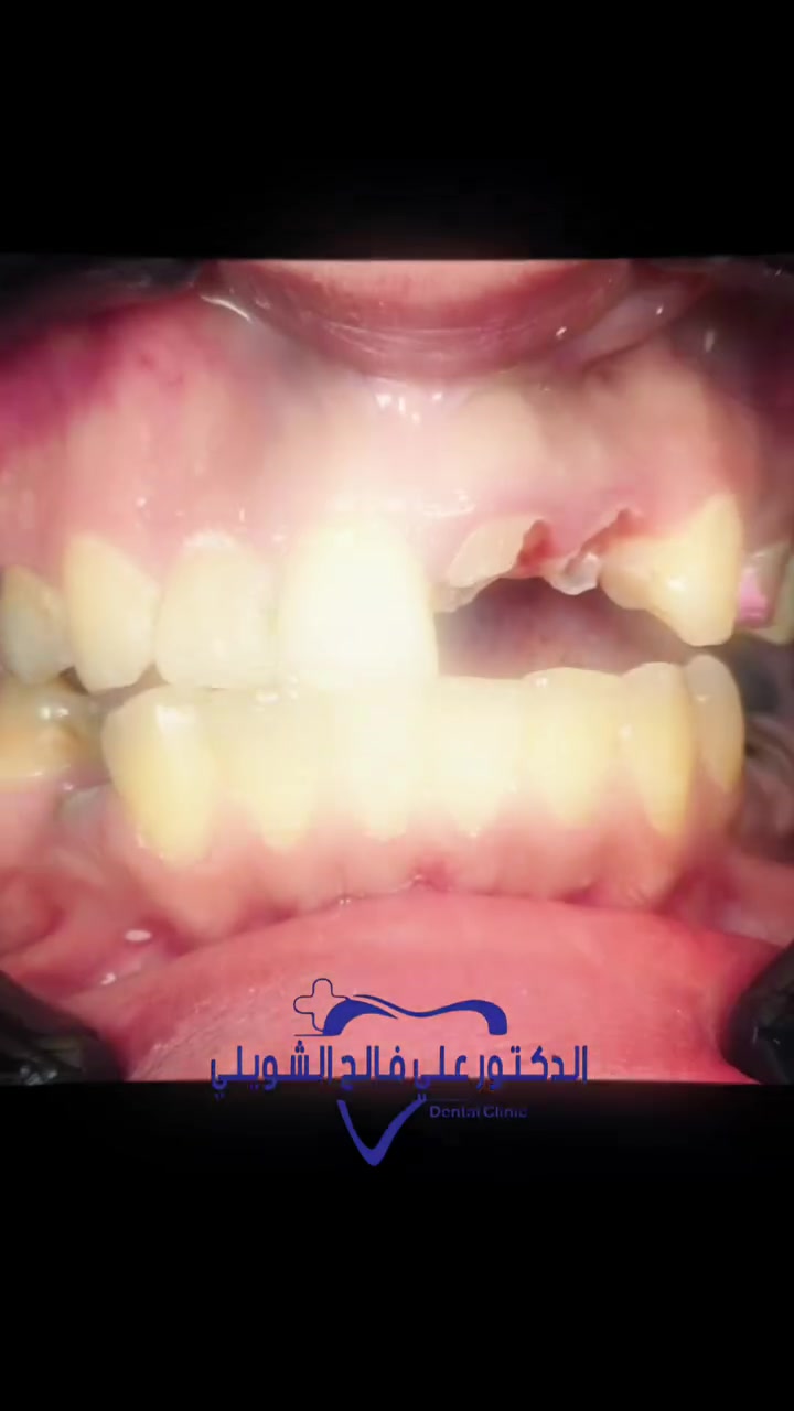 "أقوى تحول في الأسنان ممكن تشوفه! 🦷✨ شاركوني رأيكم في النتيجة، هل توقعتم هذا التغيير؟
لا تنسوا المتابعة للمزيد من تحولات الابتسامة المذهلة! 🔥👇"

عيادة الدكتور علي فالح الشويلي لطب وتجميل الاسنان 🦷🤍

قلعة سكر شارع الاطباء مجمع عين الحياة الطبي مقابل افران الربيع مجاور مطعم وطن 
رقم الحجز
*********** 
#أسنان #تجميل_اسنان #ابتسامة_هوليوود #طبيب_أسنان #قبل_وبعد تيك_توك اكسبلور
