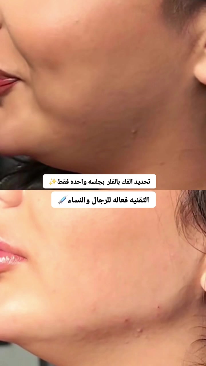 قسم التجميل 💉
السلام عليكم
على بركه اللّٰه
نعلن عن افتتاح قسم التجميل بعياداتنه الكائنه في( حي النداء شارع ٦٠)
العرض الاول للبوتوكس فقط ب85الف بدل 125
لأول5 مراجعين فقط يحصلون على جلسة البوتوكس شد الجبهة ورفع وسحبة الحاجب والتجاعيد حول العين
بوتوكس ابتسامه لثويه فقط ٥٠
بوتوكس تصغير فتحات الانف فقط ٥٠
بوتوكس صرير الاسنان ٥٠ الف فقط
بوتوكس التعرق ١٠٠ فقط
عرض الفلر لل1cc فقط 80الف بدل 100 الف الفحص والاستشاره
مجاناً
التغيير الشامل  للرجال والنساء لكل الوجه وجنات ذقن اصداغ  شفه 500 بدل 900 مع جلسه تنظيف اسنان وبلازما مجاناً
ابره الخلايا الجذعيه لتوقف تساقط الشعر وأنبات الشعر الجديد  75
يوجد أبر نضاره ومحفزات كولاجين وميزوات تفتيح وازاله
التصبغات
عليهن عروض حلوه لفتره محدوده
علما جميع المواد امنه
ومفحوصه ومسجله بوزاره الصحه
للأستفسار والحجز على الارقام الاتيه
***********
***********
