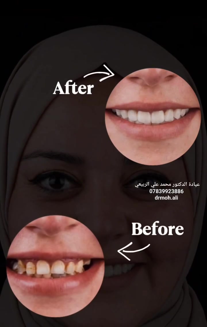 تحوّل كامل في الابتسامة

 باستخدام تركيبات الـ  E-max veneerالتجميلية! ✨( الڤنيير)

دقة في التفاصيل، مظهر طبيعي، وبدون الحاجة لبرد مفرط للأسنان.
عيادة الدكتور محمد علي الربيعي  

#محمودية تقاطع حي 17 بناية مطعم اصيل الشام

متواجدين من 10:00 صباحاً إلى 10:00مساءً

للحجز والاستفسار مراسلة الصفحة 
📞 او على الواتساب ***********
@drmoh.ali
#ابتسامة_هوليود #فينير #تركيبات_أسنان #ايماكس #طب_أسنان_تجميلي #عيادة_أسنان #المحمودية #بغداد #
