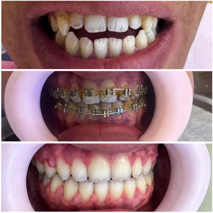 😁🦷 تقويم الأسنان… ابتسامة مرتبة تبدأ من هنا! ✨

مع الدكتورة ميس الريم 👩‍⚕️
أخصائية تقويم الأسنان

✨ ترتيب الأسنان
✨ تحسين تناسق الابتسامة
✨ متابعة وخطة علاج تناسب كل حالة

💎 خلي ابتسامتك تكون على مقاسك!

📍 الموقع: واسط – العزيزية – شارع الخليج – جانب البوابة
📞 للحجز والاستفسار: ***********

🏥 مستشفى روح الحياة الأهلي
🦷 قسم الأسنان
