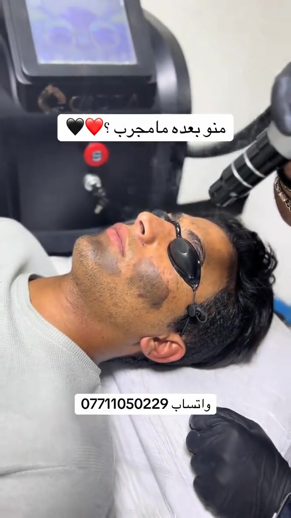تقشير كاربوني لعلاج البشره الدهنيه والتصبغات سعر الجلسه ٢٠ الف فقط العنوان بغداد الغدير ساحة ميسلون فلكة الغدير  للتواصل *********** الانستا موجود بالبايو حياكم الله بكل الايام من 12 الضهر الى 12 ليلاً #مرتضى_سنتر #تنظيف_البشرة #حلاقة #تقشير_البشرة 
