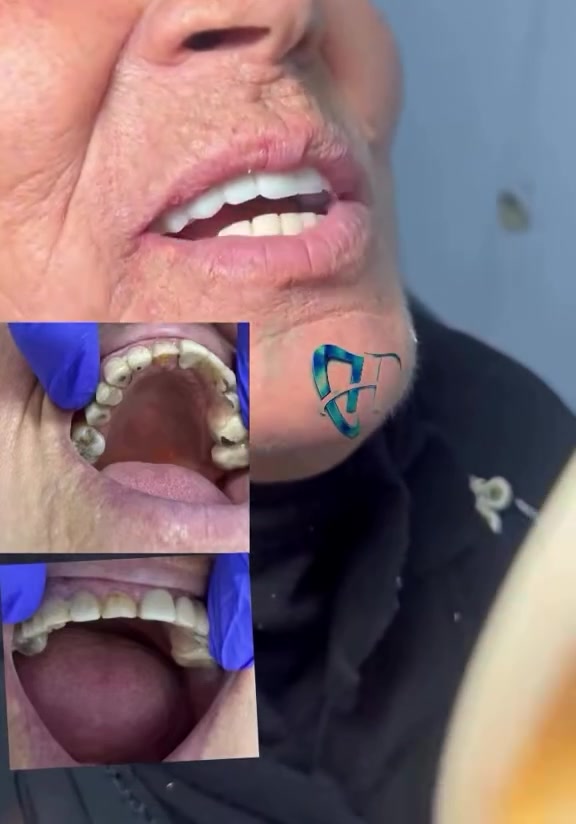 استبدال تركيبات • ابتسامة طبيعية • عيادة حسين الجابري