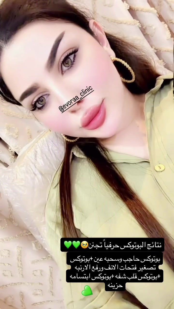 ✨ لمسات البوتوكس اللي سويتها لنفسي 💉🤍

رفعت الحاجب، سحبت العين، قلبت الشفة، صغّرت مظهر فتحات الأنف، رفعت الأرّنبة وعدّلت الابتسامة الحزينة ✨

والنتيجة؟ فرق ناعم ومرتب بدون مبالغة 🤍

إذا تحبين تعرفين شنو يناسب ملامحچ، خلي تقييمچ على إيد مختصة 🌷

Evora Clinic 🤍
� العنوان: حي الجامعة – قرب صيدلية السوسن
📞 للحجز والاستفسار: ***********

 @إشارة #اكسبلور
