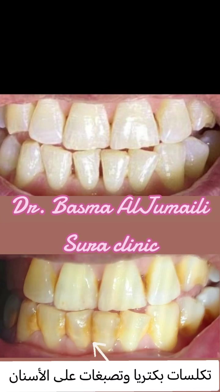 سلام عليكم ورحمة الله وبركاته
✨ فرصة مميزة لعلاج أسنانك بأسعار رمزية 🦷
طبيبة أسنان حاصلة على عدة شهادات ودورات تدريبية في مجال طب الأسنان، تقدم خدمات علاجية لمختلف الحالات بأسعار رمزية تصل إلى نصف السعر.
🔹 يشمل استقبال مختلف الحالات السنية
🔹 أسعار مناسبة ومخفضة
🔹 يتم توثيق ودراسة كل حالة ضمن بحث علمي بهدف تطوير الخبرة والجانب العلمي والسريري.
🔷 بيئه آمنه ومعقمه لكل مراجع ادوات خاصه به يتم التخلص منها بعد انتهاء الجلسه. 
📍 للحجز والاستفسار:
📱 واتساب: ***********

العلاج بامانه تامه ويوجد كارت ضمان مع تقرير كامل لحالة كل مريض وتتوفر صور لحالات علاجية من شغلنا على صفحتي الخاصه 📸

