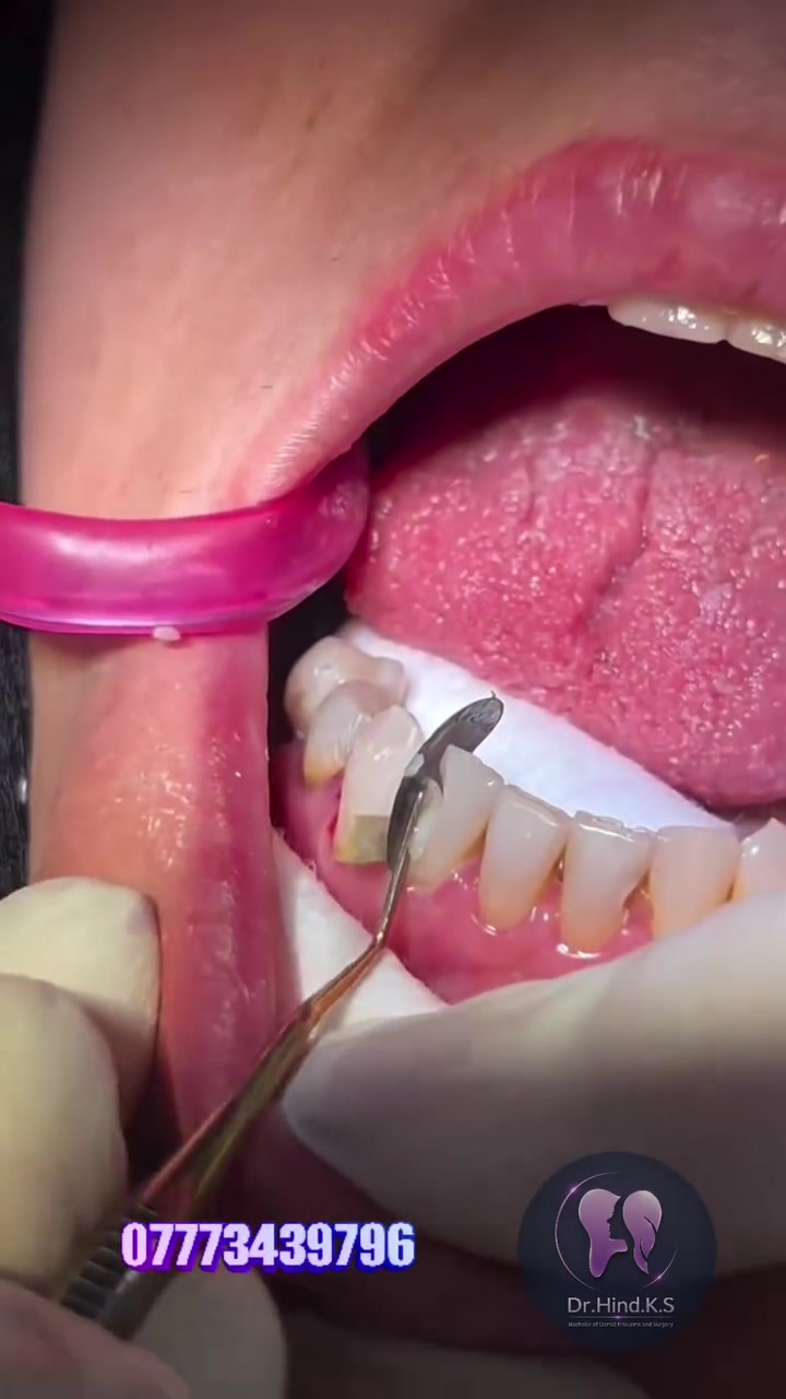 مو كل تغيير يحتاج برد أو تغليف 😉🦷
أحياناً حشوة تجميلية مرتبة تسوي فرق يبين من أول نظرة ✨

وبمناسبة الخصومات الحالية، الحشوات التجميلية عليها خصم لفترة محدودة 🔥

📞 للحجز والاستفسار: ***********
📍 بغداد – الأمين الثانية – النواب – شارع المهداوي

شوفوا النتيجة واحكموا بنفسكم 😍
