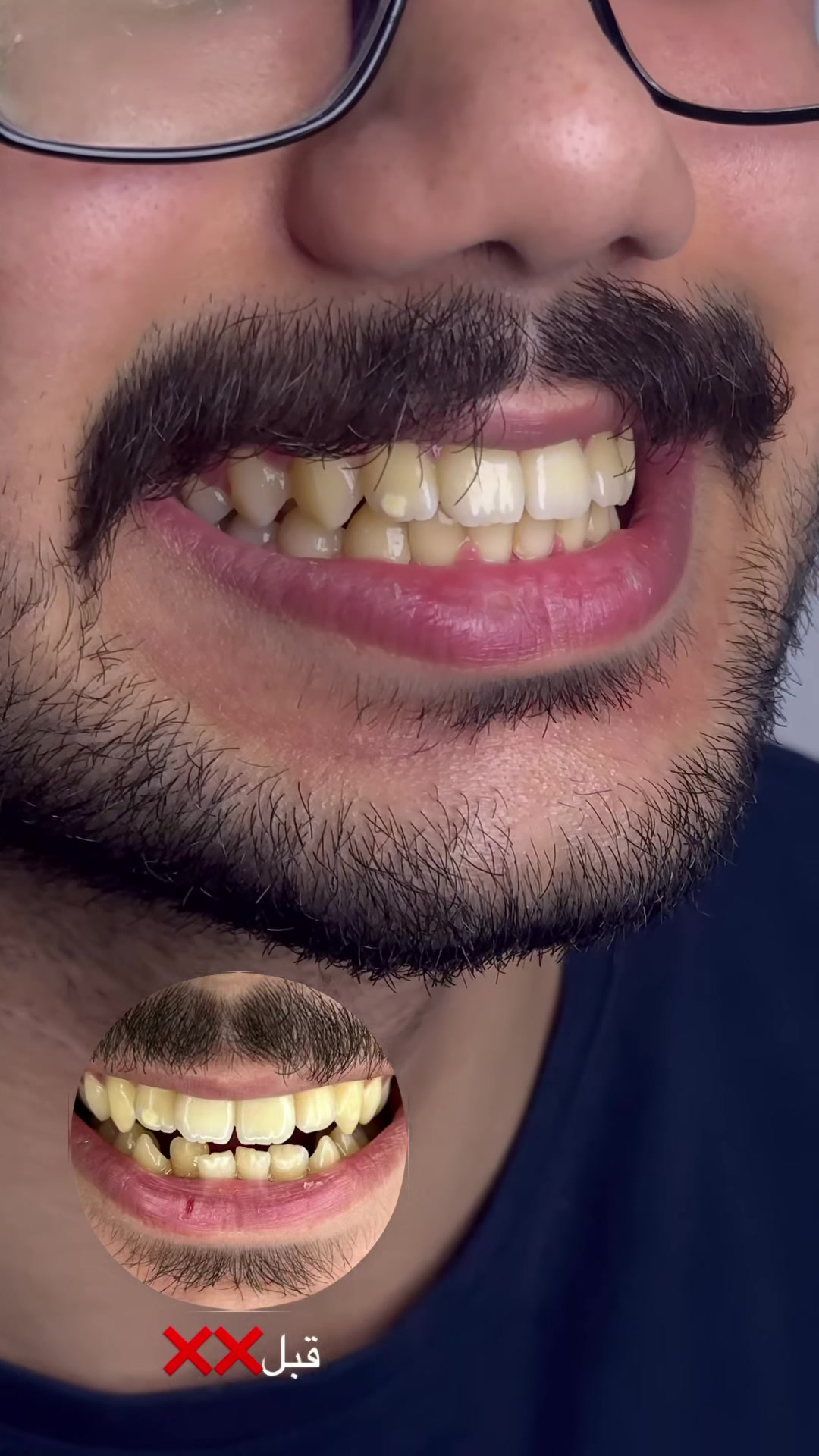 النتيجة تحچي بنفسها #قبل_وبعد #تقويم_الأسنان #ابتسامة_مثالية #عيادة_تجميل
