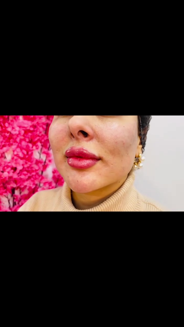 عيادة رسل كلينك

—————————————-
العرض الاول  البوتوكس( لمعالجة التجاعيد والخطوط الرفيعه)  65الف  
العرض الثاني بوتوكس علاج التجاعيد الوجه كامل مع ابرة نضاره تفتيح البشره 100 الف
—————————————
👄🍒
فلر شفه الكوري  25 الف عرض 
فلر شفه سويسري 35  عرض 🍒
نيوفيا 135
تيوسيال 200
فلوركا 145
——————————————-
عرووض الفر 
فلر  اصداغ 20 الف فقط
فلر وجنات كل 4سيسي 100 الف 
الخامس مجاني 🎁🌸
عرض التغير الشامل يشمل :- فلر كوري
(اصداغ ،رفع وجنات،معالجة الخطوط الضاحكة 
تعديل ذقن رسمة عضمة الفك).   =200  الف فقط⚡️⚡️
____________________ …
 🥥عروض النضارة الاول
 ابره الطماطه  نضاره وتوريد طبيعي 35 الف فقط
💫ابرة النضارة والترطيب Dermofil 50 الف ره
ألفتن تبيض نضارة فوريه 50 الف
كيارا كولاجين تبيض نضارة 60 الف
هايرون هايرولنك اسد 25 الف
بلازما الوجه 20 الف
بلازما الشعر 20 الف
———————————
تنظيف بشره 
عرض الصديقات👩‍❤️‍💋‍👩
تنظيف بشره عميق بجهاز الهيدروفيشيل مع بخار لازاله الرؤوس السوداء وازاله الجلد الميت مع مسكات والمقشرات وماسك النيله
الشخص الواحد 10 الاف
————————————- 
🥥أبر النضاره العرض الثاني 🎀
-علاج التصبغات الجلسة 30 الف
- ابره العنبر ٢٥ الف فقط
- ⁠ابره الكالسيوم  ٢٥ الف فقط 
- ⁠ابره السلمون (pdrn) ٢٥ الف فقط
- ⁠ابره الكولاجين … ٢٥ الف فقط 
- ⁠سكن بوستر هايرون 25 الف فقط 
مذيب اللغلوغ 25 الف
ميزو معالجة الهالات السوداء 20 الف فقط
نضارة ديرمابن 15  الف 
ميزو علاج حب الشباب من اول جلسه 25 الف
ميزو معالجة تساقط الشعر 20 الف🌸

💟💟التغير الشامل 🤍🤍🤍🤍
(((بوتوكس +فلر شفه+فلر اصداغ +وجنات +تحديد ذقن ورسمة تكساس ومعالجة الخطوط الضاحكة-=400الف))
عروض السكرت ؛  معالجة اثار حب الشباب
                         ازالة الندب 20 الف
الليزر⚡️⚡️⚡️ فول بدي 80 الف
البكيني 20
الابط 20
نصف يد 20
نصف ساق 20
_____________،،،،،،،
العنوان الاول //بسمايه
 الثاني //بغداد التأميم قرب فلكه المدائن /شارع ٦٠ / عياده رسل كلينك 
*********** #أكسبلور #اكسبلورمشاهير #بسماية_بغداد_بسماية_مول_العراق_مشاهير_انستكرام_تويتر #المدائن_سلمان_باك  Russel Clinic
