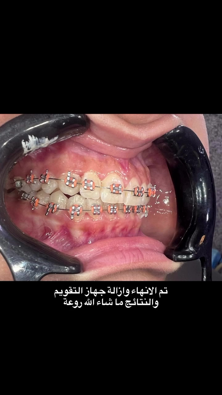 التقويم يميزنا الف مبروك ازالة جهاز التقويم والنتائج روعة فرحة المريض لاتوصف حيث كان يراجع احد الاطباء و قد قضى مدة طويلة و لم يتغير او يحصل نتيجة و جاء إلى عيادتنا و تمت المعالجة يعاني من مظهر خارجي غير متناسق و عدم القدرة على غلق جانبي الفم في الوقت الواحداو عدم التوازن و انزعاجات شديدة و مشاكل اخرى … علاج جميع الحالات و المشاكل المعقدة و المستعصية نتائج مضمونة خبرة طويلة في علاج حالات المستعصية ابتسامة مثالية اسعار مناسبة بالتقسيط المريح… دكتور غزوان مزهر بغداد الكرخ نفق الشرطة بداية شارع الاطباء عيادة لوركا فوق صيدلية كنز النفق متوفر واتس *********** #تقويم_الأسنان_قبل_وبعد #تقدم_الفك_العلوي_السفلي #العضة_المفتوحة #تقويم_الأسنان_والفكين #العضة_المعكوسة @حشوات_الاسنان @حشوات_الجذور
