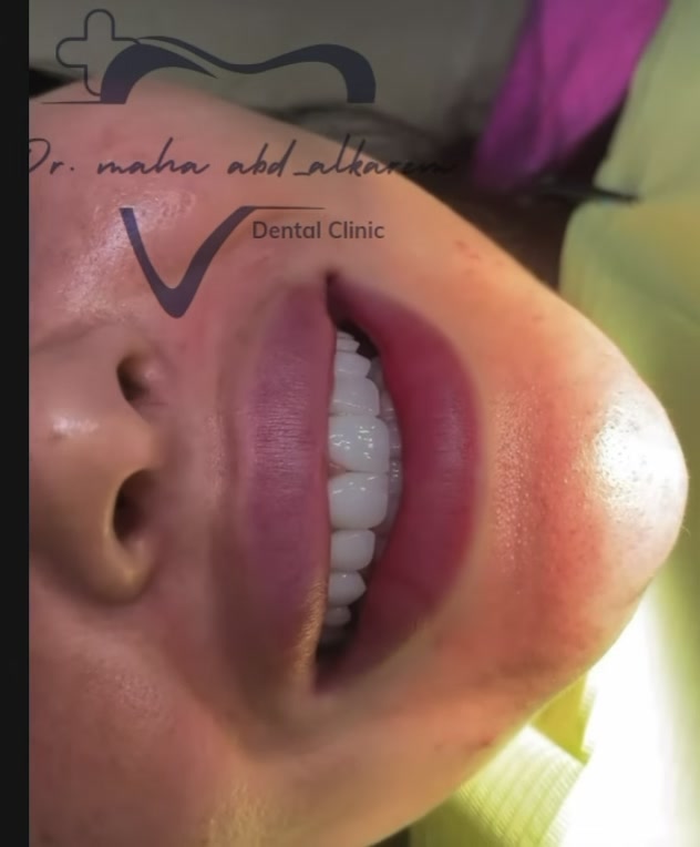 هوليود سمايل ايماكس بلون ابيض طبيعي حسب رغبه المراجعة

….🔥🔥🦷

يوجد نظام الاقساط والدفع بالنقد 
.
.
.
عنوان العيادة 🦷🤍✨

الرمادي _شارع المستودع _مجمع النخبة الطبي 
مبنى المحافظة مقابيل الضريبة القديمة مباشرة
 

للحجز والاستفسار الاتصال ع الرقم: ***********
او مراسلة صفحة العيادة 

أوقات الدوام من الساعة من ١١ صباحاإلى الساعة ٩ ليلا
