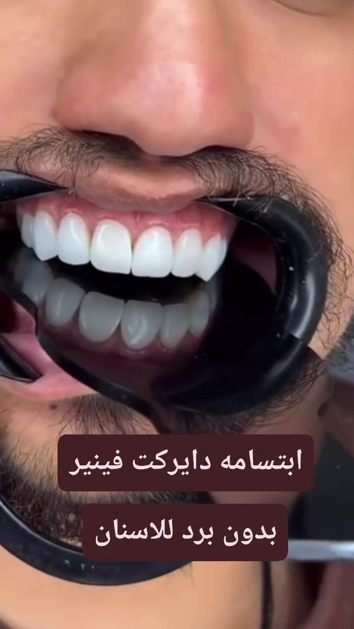 على أغنية ماجد المهندس 🎶 «سويلي موعد» 😍

إذا ناوي تغيّر ابتسامتك… هذا وقتك 🦷✨
العروض حتخلص، لا تخلي الموعد يروح عليك 😄

للحجز والاستفسار راسلونا خاص 📩
د. هند الحسيني 🤍
***********
