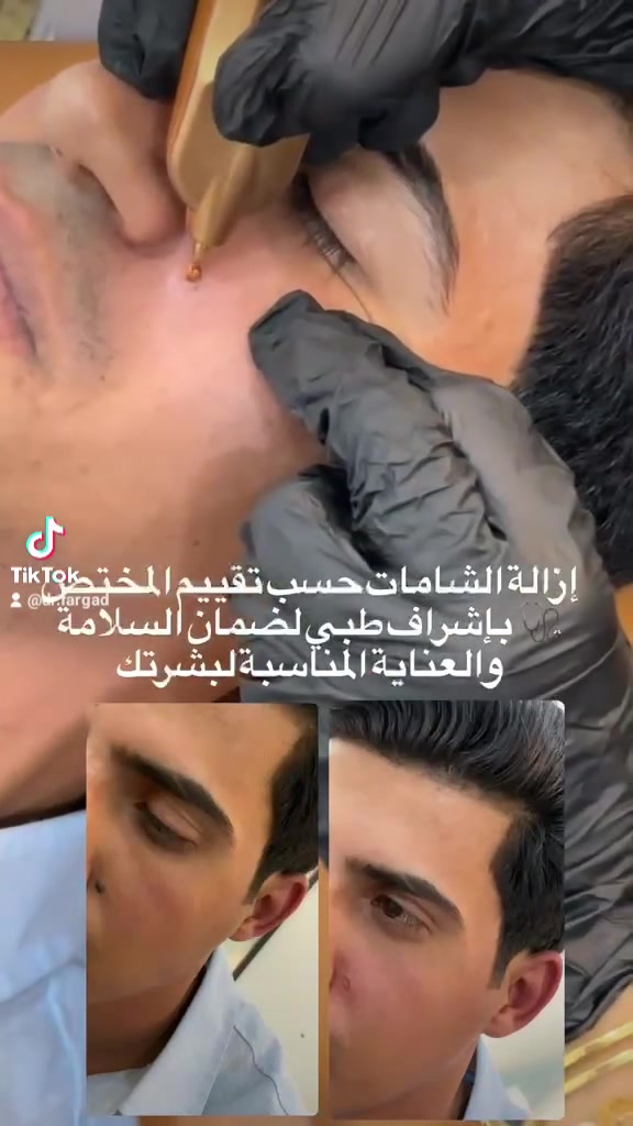 سما بيوتي • تجميل لاجراحي • بوتوكس فيلر