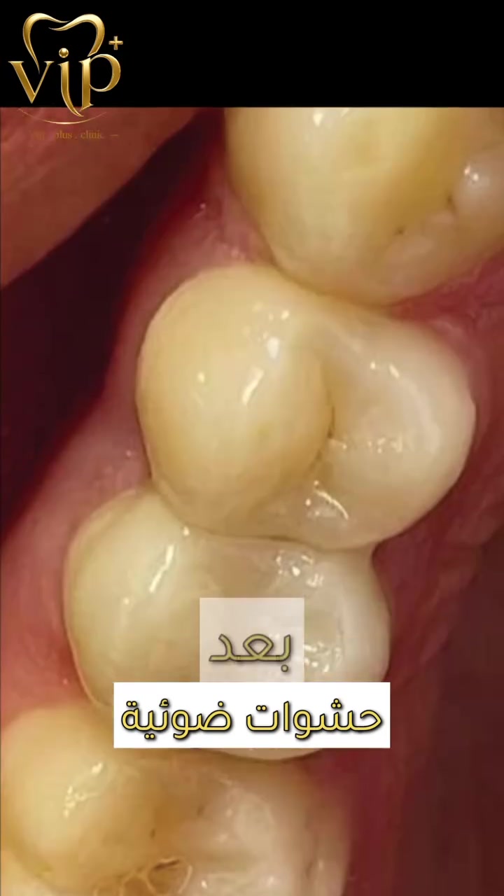 حشوات ضوئية • VIP • البصرة