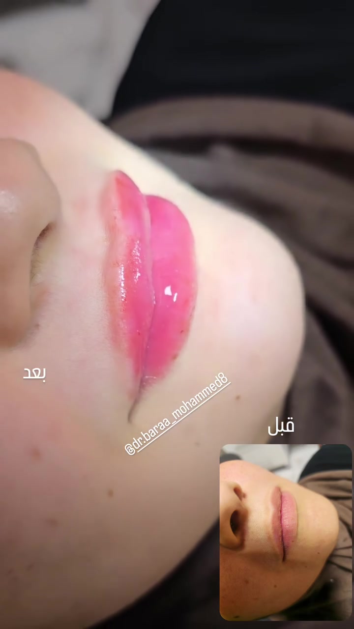 فلر شفة💉👄
د. براء محمد خليل الدليمي
بيجي _شارع الأطباء _مجاور مختبر الوسام
 #بيجي #صلاح_الدين #تجميل #اسنان #تكريت #العراق

