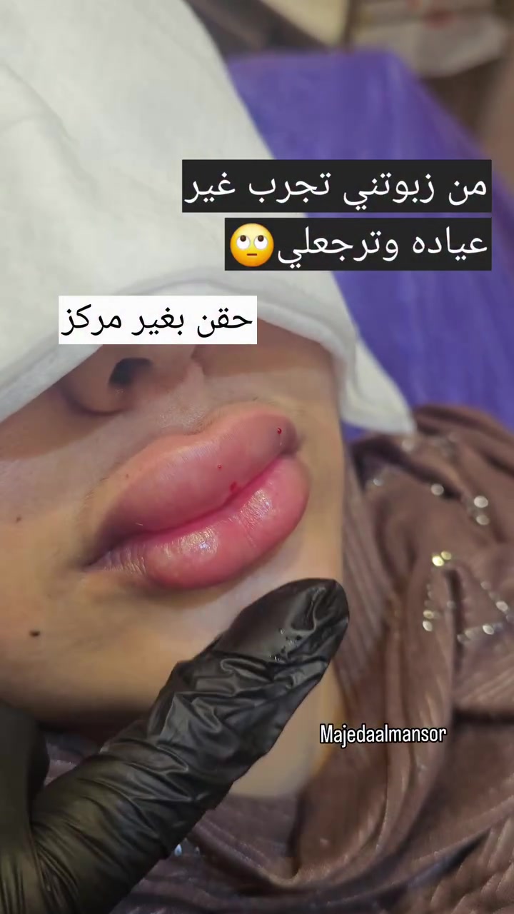 بغداد الحسينيه • بوتكس • فلر الشفايف