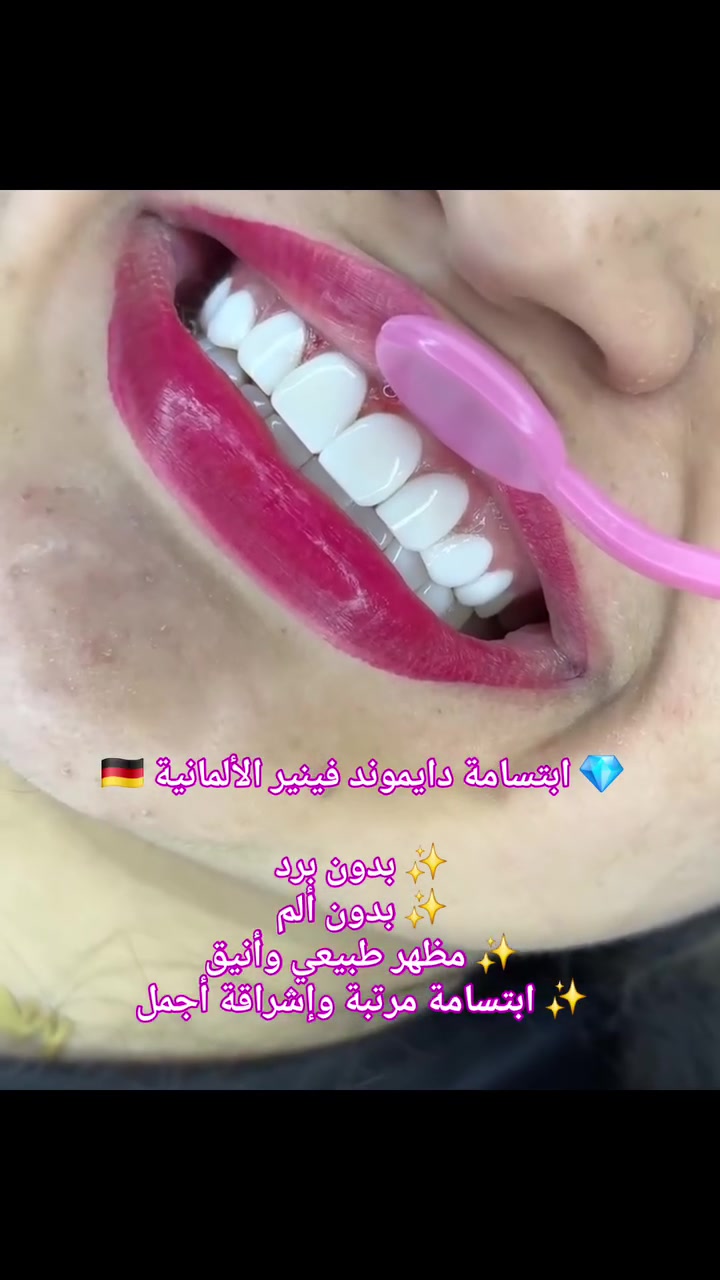 ✨ تريدون ابتسامة تغيّر الشكل؟
@highlight 
دايموند فينير الألمانية 🇩🇪💎
بدون برد وبشكل طبيعي وأنيق 🤍

📞 ***********
📍 الأمين الثانية – النواب – شارع المهداوي
