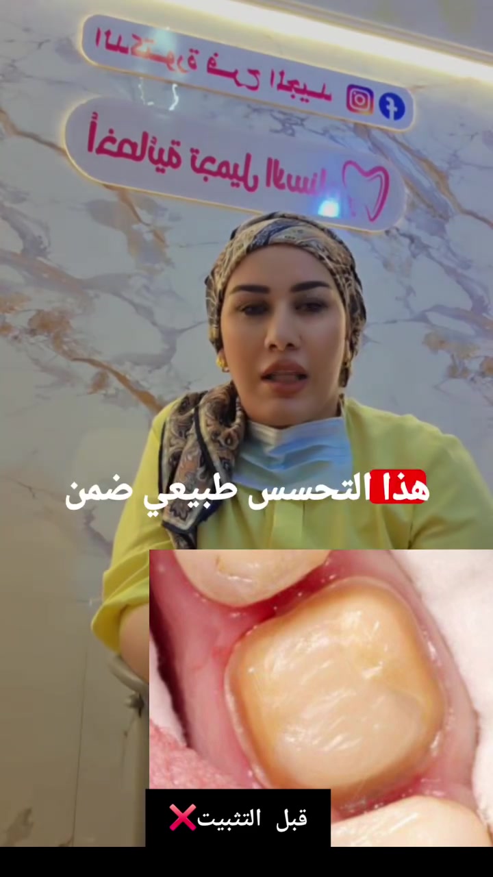 تجميل أسنان • أغلفة زاركون • تحسس الأسنان