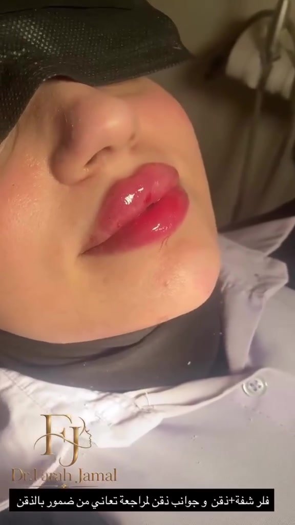الدكتورة فرح جمال الطائي

نص مكتوب في الصور:
- Dr.Farah Jamal الحجز داخل العيادة حصرا نستلم عدد معين لا يوجد حجز مسبق شكراً لتفهمكم وثقتكم متواجدين غداً الجمعة من 3:30 الى 9 مساءً ،العروض مستمرة ويوجد نظام الاقساط بدون مقدمة لحاملي ماستر الرافدين والرشيد
- تتوفر خدمة التقسيط لحاملي بطاقة ماستر الرشيد على كافة خدمات العيادة في قسمي التجميل والاسنان اقساط بدون مقدمة تصل لمدة سنة كاملة قسم التجميل فلر بوتوكس نضارة و تفتيح الدكتورة فرح جمال الطائي *********** واتساب قسم الاسنان ابتسامة المشاهير حشوات تجميلية حشوات جذور تركيب الاسنان الثابتة والمتحركة تبييض الاسنان زراعة الاسنان قلع وكذالك تتوفر اقساط لحاملي ماستر الرشيد