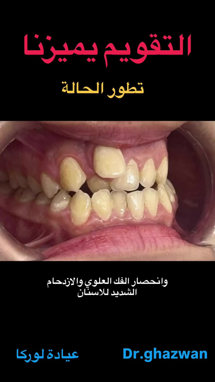 تقويم الفكين • حالات مستعصية • الكرخ نفق الشرطة
