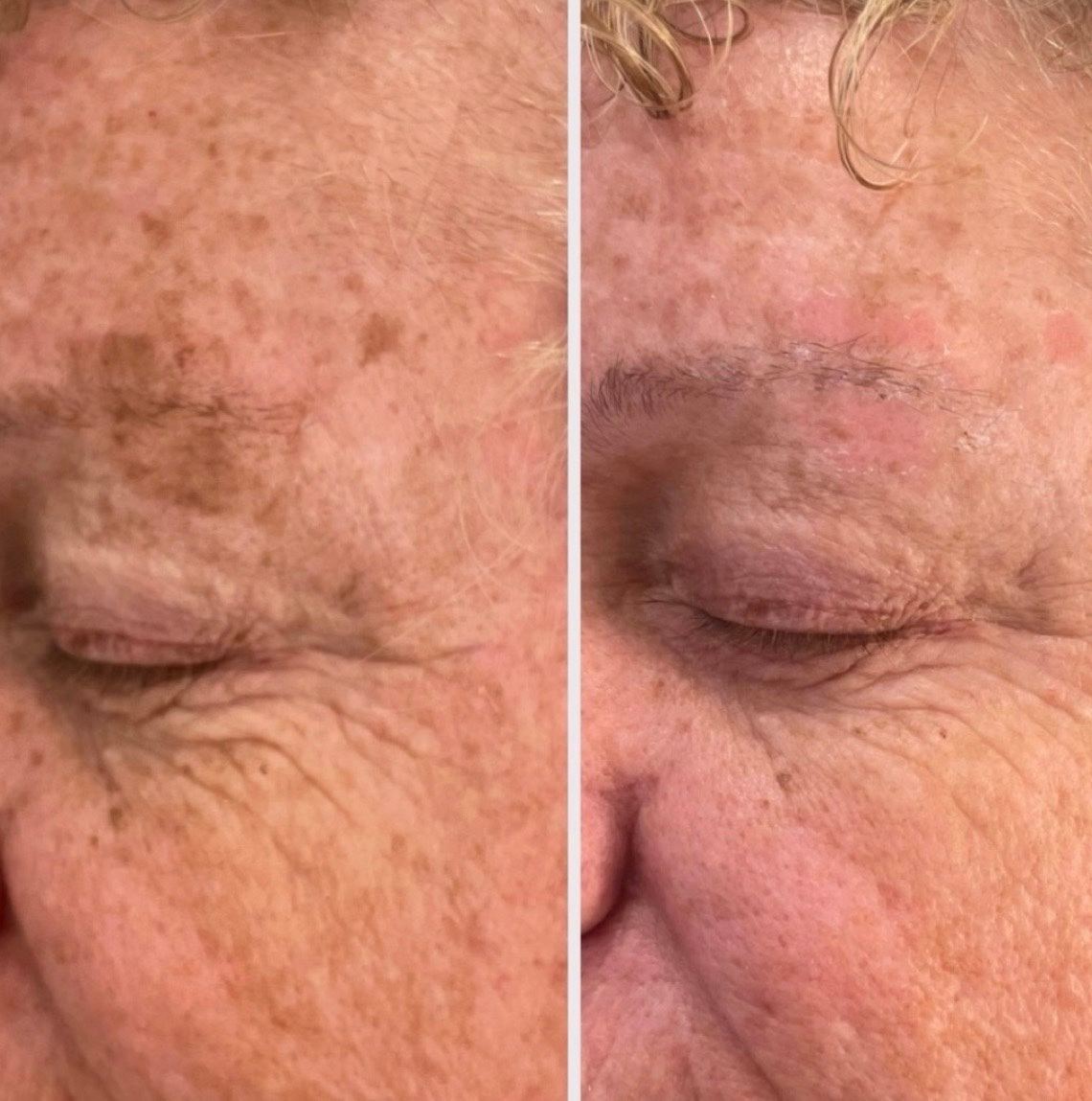 Jet Plasma Skin Treatment