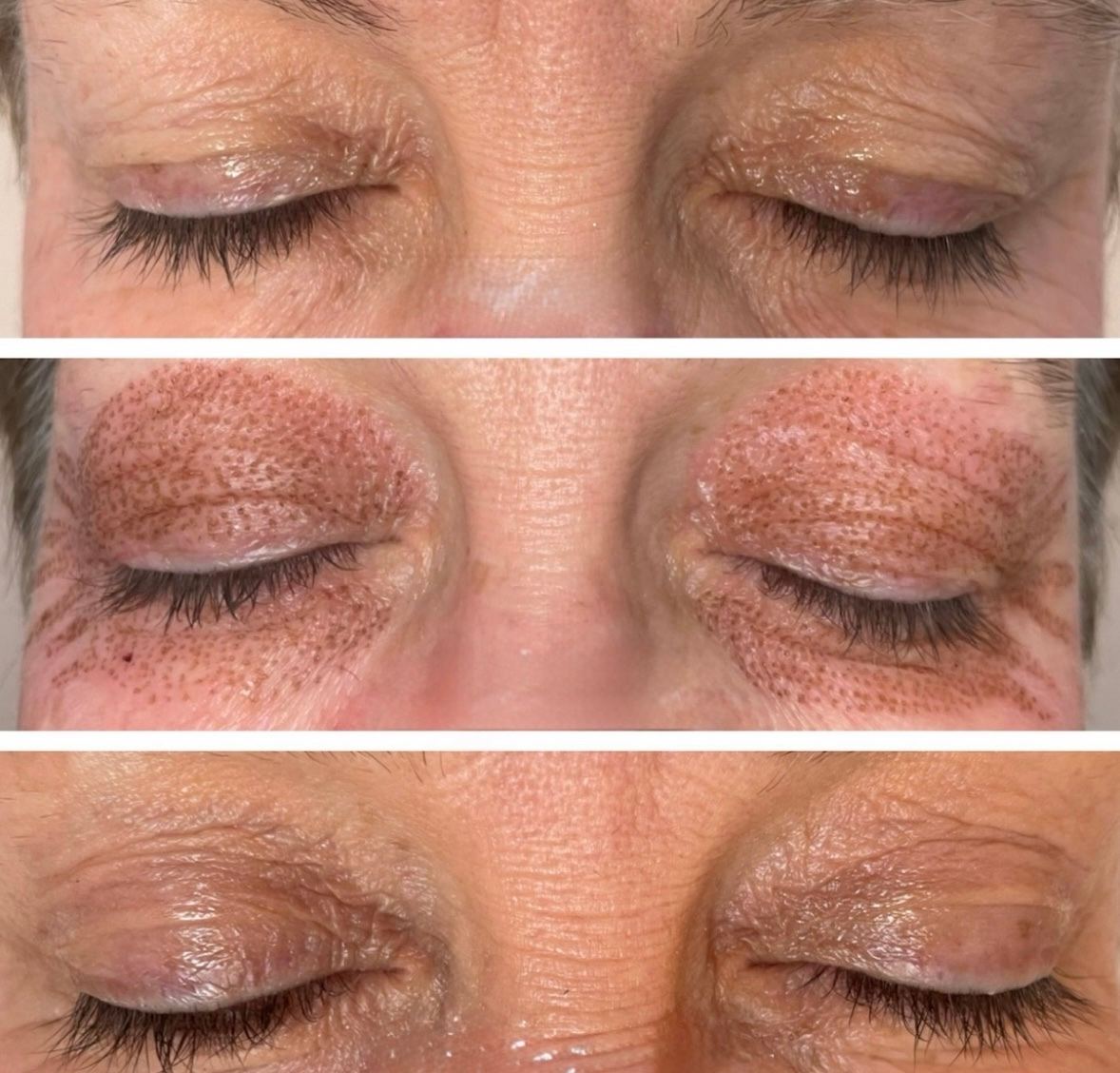 Fibroblast Skin Treatment