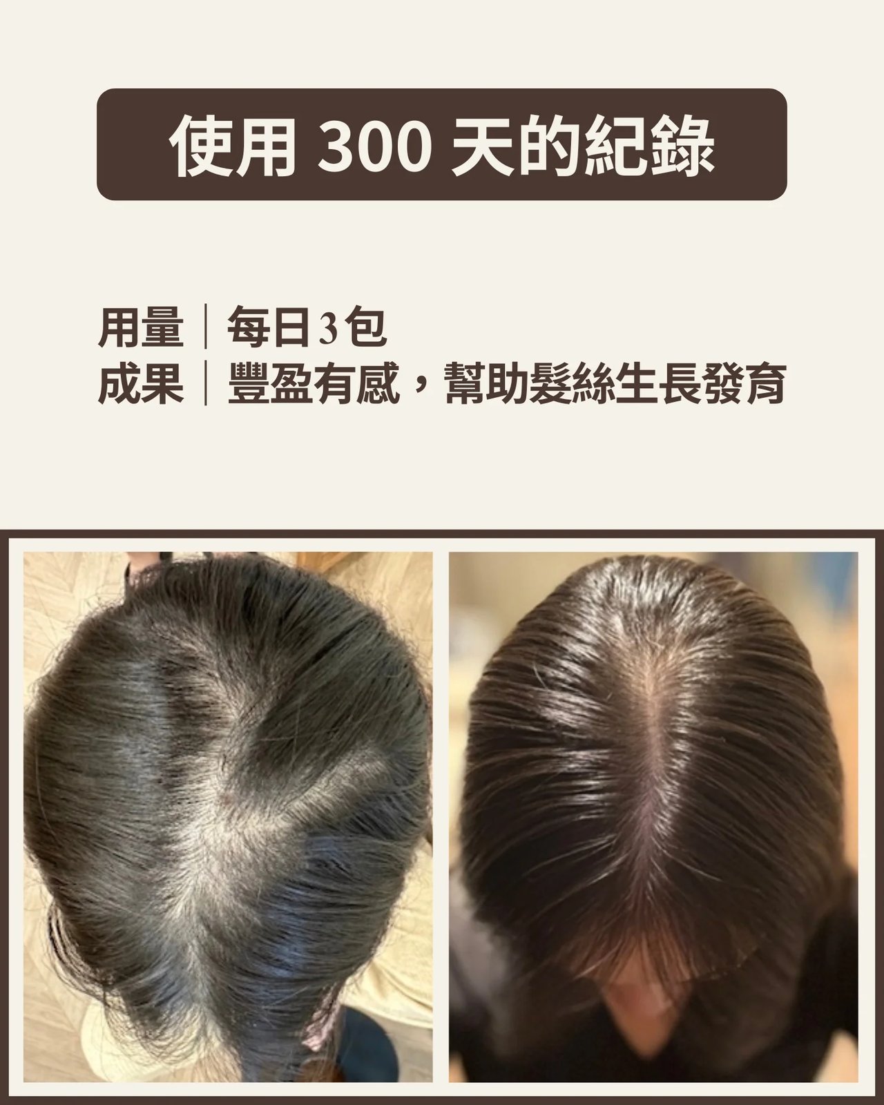 頭頂髮量使用前後對比照，個人實際效果因體質而異