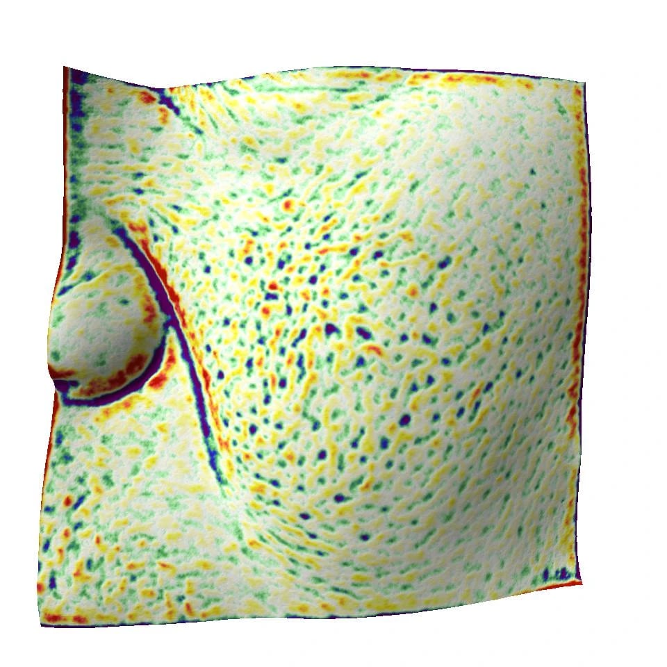 油性痘痘肌受試者使用前：Antera 3D 基線量測