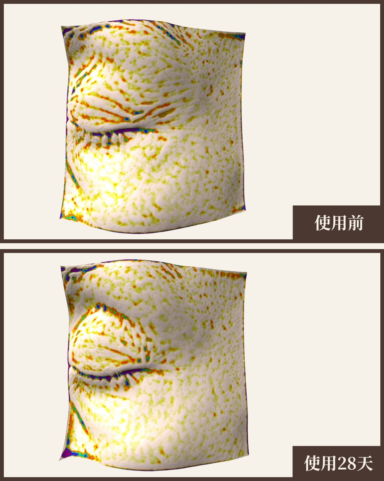 受試者01 眼周皺紋 Antera 3D 量測對比