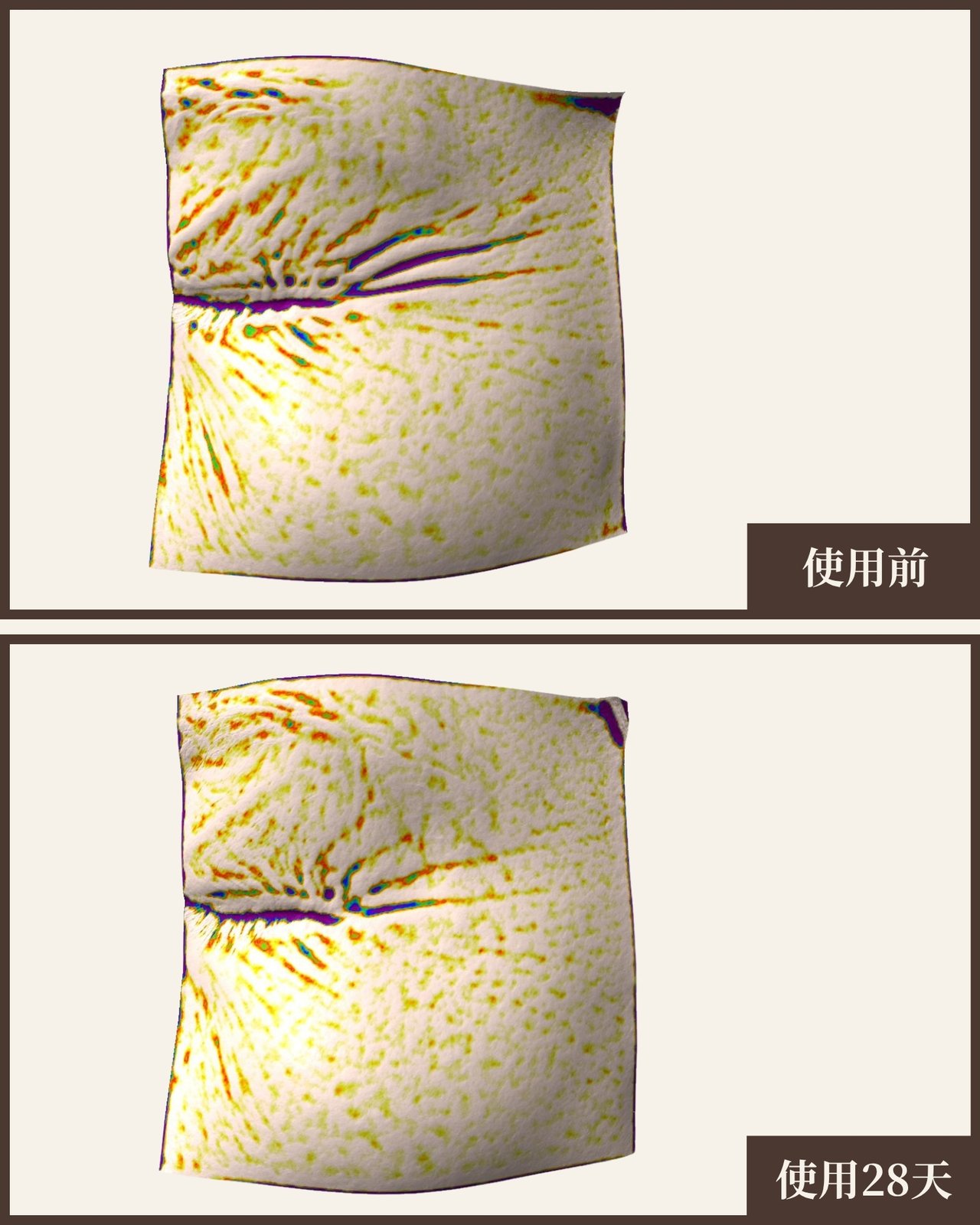 受試者25 眼周皺紋 Antera 3D 量測對比